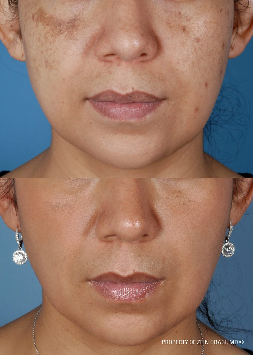 ZO skincare before and after.