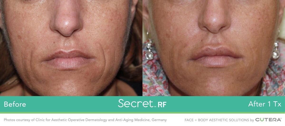 Secret RF before and after image.