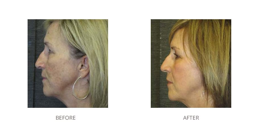 Fractional laser before and after.