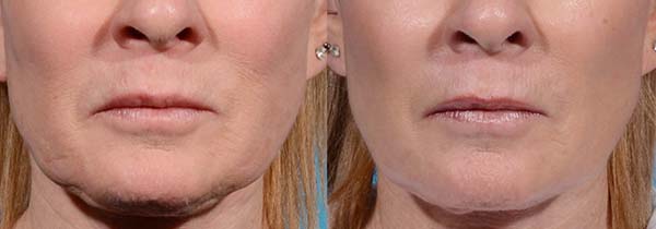 Before and after of the chin courtesy of Dr. E. Dayan & Dr. R Rohrich