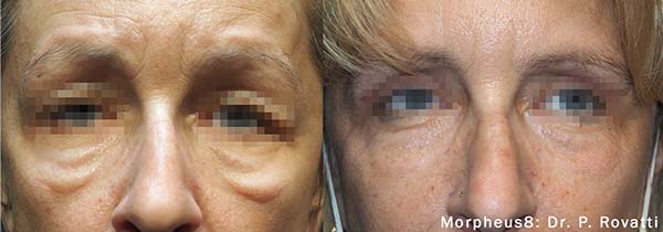 Before and after of the lower eyes. Courtesy of Dr. P Rovatti