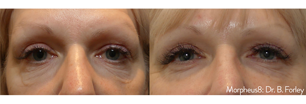 Before and after of eyes by Dr. B. Forley