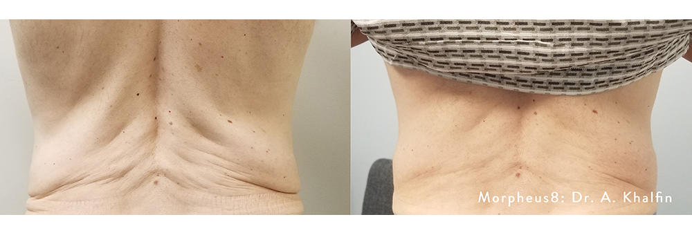 before and after of the back by Dr. A Khalfin