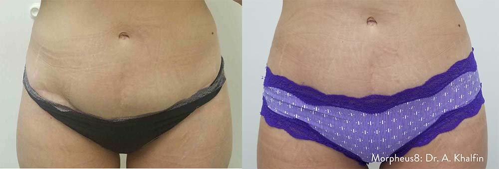 Before and after of abdomen by Dr. A. Khalfin