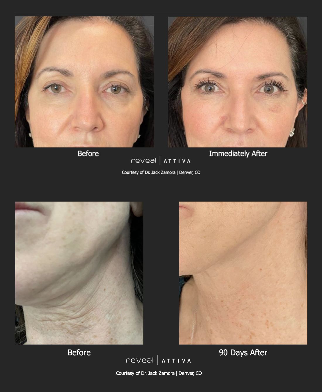 Before and After Attiva RF treatment