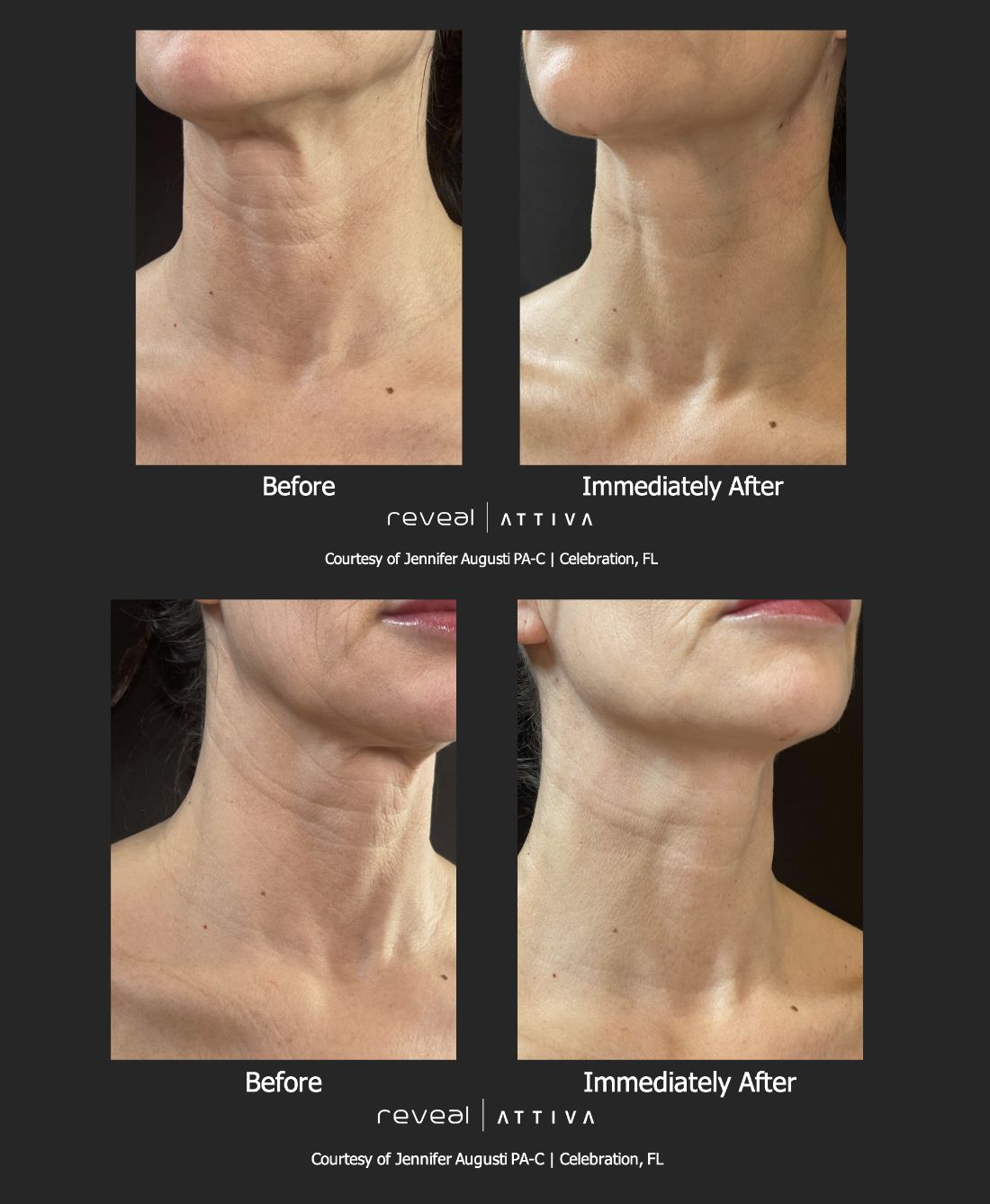Before and After ATTIVA treatment